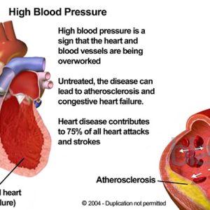 High Blood Pressure Reviews: Navigating Solutions for Hypertension