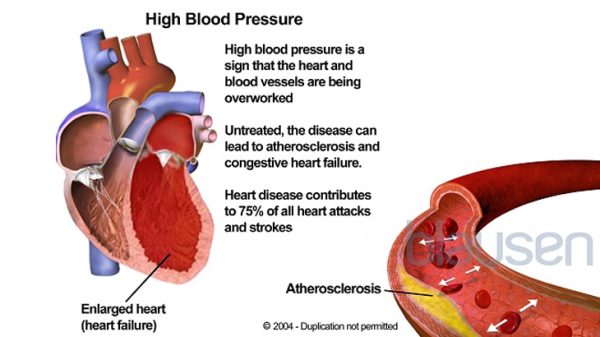 High Blood Pressure Reviews: Navigating Solutions for Hypertension